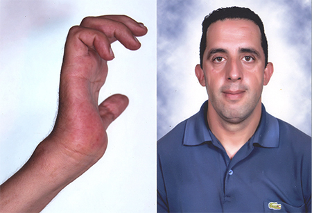 مواطن يلتمس تدخل جلالة الملك:تعرضه لحادثة سير أصابته بعجز على مستوى يده اليمنى ..