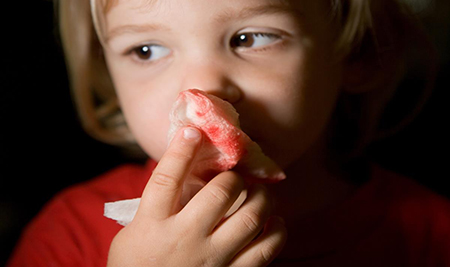 الإسعافات الأوليّة لنزيف الأنف