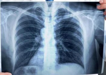 تخليدا لليوم العالمي لداء السل: الصحة تطلق حملة للكشف المبكر