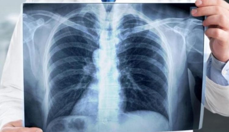 تخليدا لليوم العالمي لداء السل: الصحة تطلق حملة للكشف المبكر