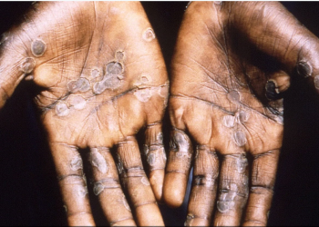 تسجيل حالة إصابة مؤكدة بفيروس جذري القردة بالمغرب