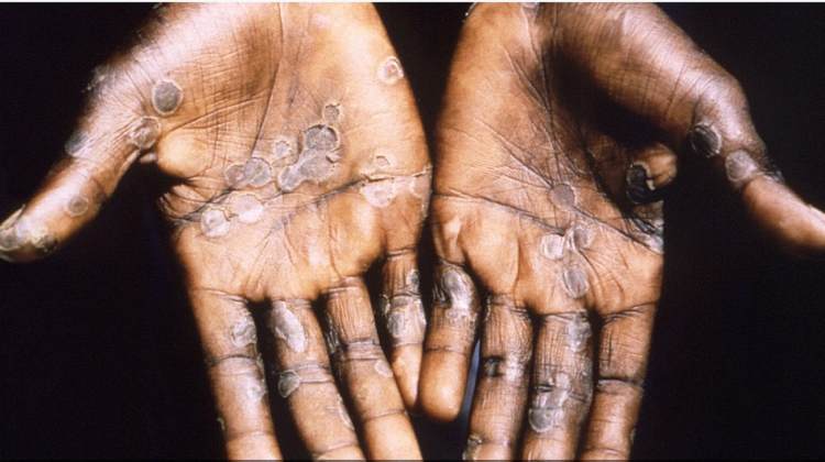 تسجيل حالة إصابة مؤكدة بفيروس جذري القردة بالمغرب