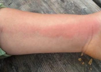 داء تسمم الدم .. إطلاق حملة تواصلية للتحسيس بأهمية الوقاية من هذا المرض